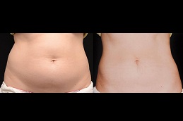 best coolsculpting fat freezing in islamabad