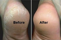 best cracked heels treatment in islamabad