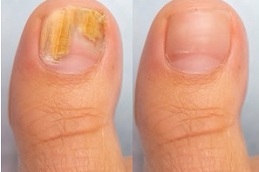 best fungal nail infections in islamabad