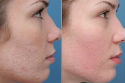 best laser treatment for acne scars permanent in islamabad
