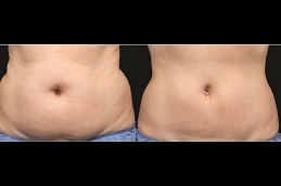 best non surgical fat reduction cost in islamabad