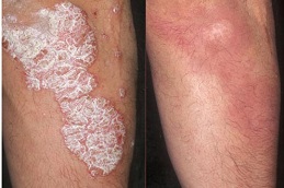 best psoriasis treatment cost in islamabad