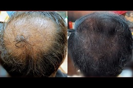 best trichologist for hair transplant in islamabad