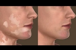 best vitiligo treatment in islamabad