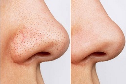 best whitehead blackhead removal in islamabad