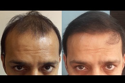 biofibre hair transplant in islamabad