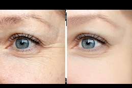 botox for wrinkles treatment in islamabad