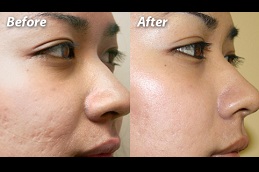 can laser treatment remove acne scars completely clinic in islamabad