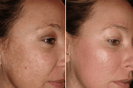 can laser treatment remove acne scars completely clinic in islamabad