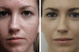 can laser treatment remove acne scars completely in rawalpindi