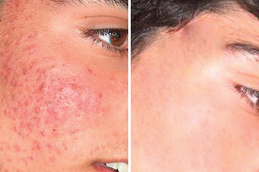 chicken pox scar removal Clinic in islamabad
