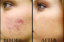 chicken pox scar removal in islamabad