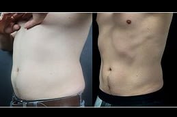 coolsculpting fat freezing Clinic in islamabad