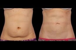 coolsculpting fat freezing in islamabad