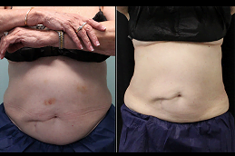 coolsculpting fat freezing in rawalpindi