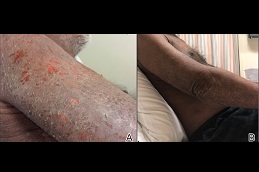 dermatitis treatment in rawalpindi
