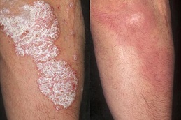 doctors for psoriasis treatment in islamabad