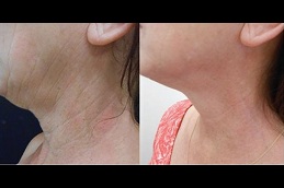 dull neck skin treatment Clinic in islamabad