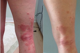 eczema treatment in rawalpindi