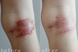 eczema treatment pros and cons in islamabad
