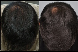 finasteride for hair loss clinic in islamabad