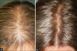 finasteride for hair loss in rawalpindi