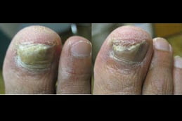 fungal nail infections Clinic in islamabad