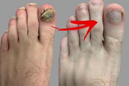 fungal nail infections in islamabad