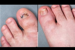 fungal nail infections in rawalpindi