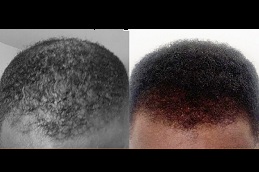 hair transplant for black males Clinic in islamabad