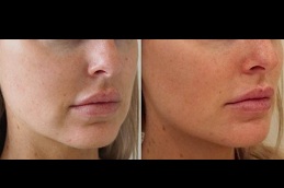 jawline filler price Clinic in islamabad