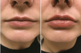 lip-augmentation in ISLAMABAD