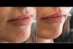 lip-augmentation in RAWALPINDI