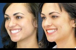 non surgical dimple creation for women in islamabad
