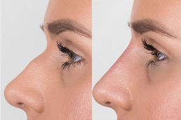 nose fillers injections Clinic in islamabad
