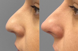 nose fillers injections in rawalpindi