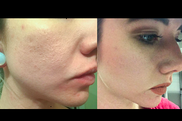 open pores treatment by dermatologist in islamabad