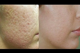 open pores treatment by dermatologist in rawalpindi