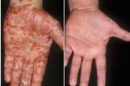 psoriasis treatment cost Clinic in islamabad