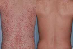 psoriasis treatment cost in islamabad