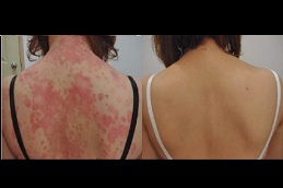 skin allergy treatment in islamabad