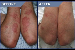 skin allergy treatment in rawalpindi