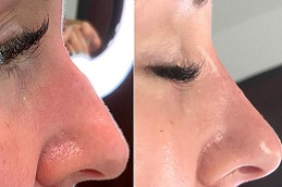 threads treatment for non surgical rhinoplasty Clinic in islamabad