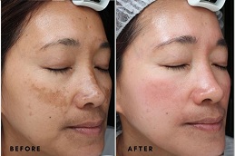 treatment for pigmentation on face in rawalpindi