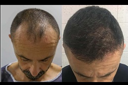 trichologist for hair transplant in islamabad