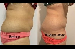 Best adipose lipolysis injection in rawalpindi