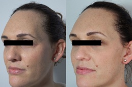 Best botox vial price Clinic in islamabad