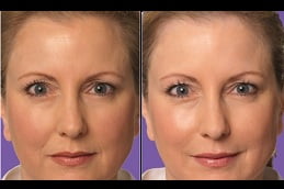 Best juvederm fillers clinic in islamabad