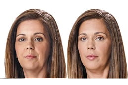 Best juvederm fillers in rawalpindi