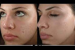 Best laser treatment good for your skin clinic in islamabad